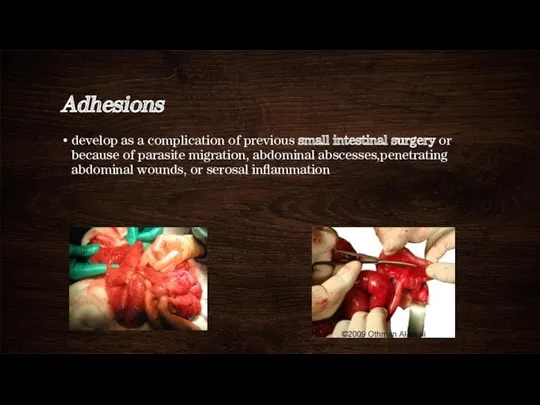 Adhesions develop as a complication of previous small intestinal surgery or because of