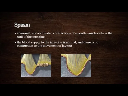 Spasm abnormal, uncoordinated contractions of smooth muscle cells in the wall of the