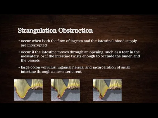 Strangulation Obstruction occur when both the flow of ingesta and the intestinal blood
