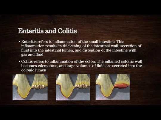 Enteritis and Colitis Enteritis refers to inflammation of the small intestine. This inflammation