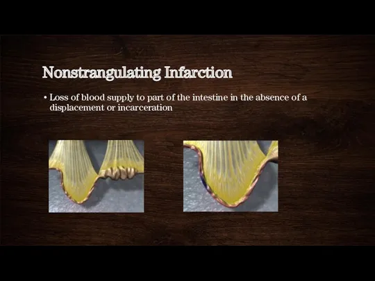 Nonstrangulating Infarction Loss of blood supply to part of the intestine in the