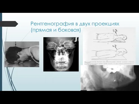 Рентгенография в двух проекциях (прямая и боковая)