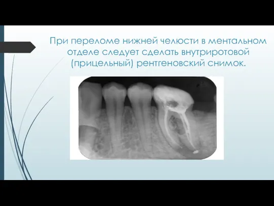 При переломе нижней челюсти в ментальном отделе следует сделать внутриротовой (прицельный) рентгеновский снимок.