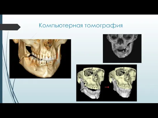 Компьютерная томография