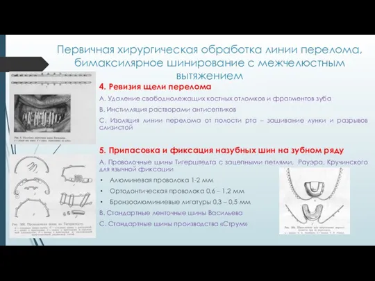 Первичная хирургическая обработка линии перелома, бимаксилярное шинирование с межчелюстным вытяжением