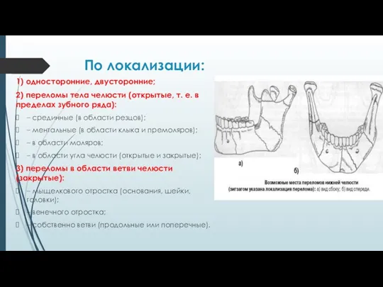 По локализации: 1) односторонние, двусторонние; 2) переломы тела челюсти (открытые,