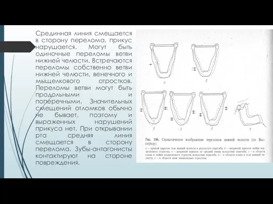 Срединная линия смещается в сторону перелома, прикус нарушается. Могут быть