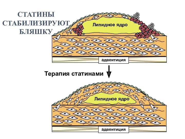 Липидное ядро адвентиция адвентиция Липидное ядро СТАТИНЫ СТАБИЛИЗИРУЮТ БЛЯШКУ Терапия статинами