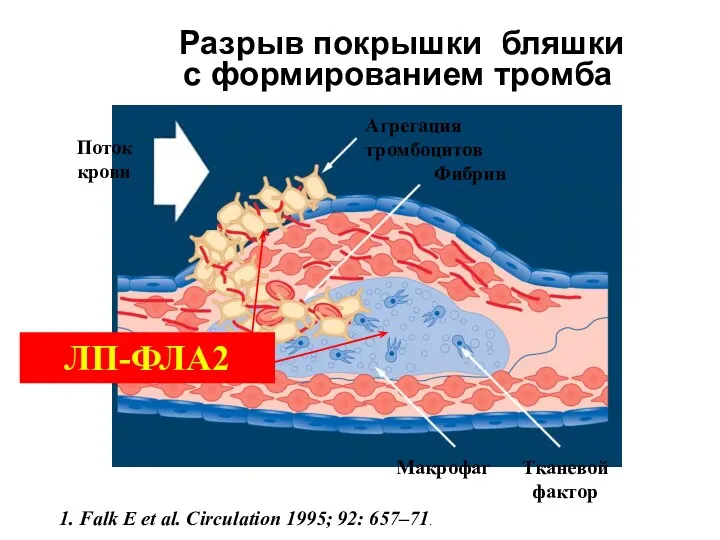 Разрыв покрышки бляшки с формированием тромба 1. Falk E et al. Circulation 1995; 92: 657–71. ЛП-ФЛА2