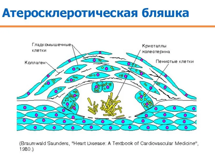 Атеросклеротическая бляшка