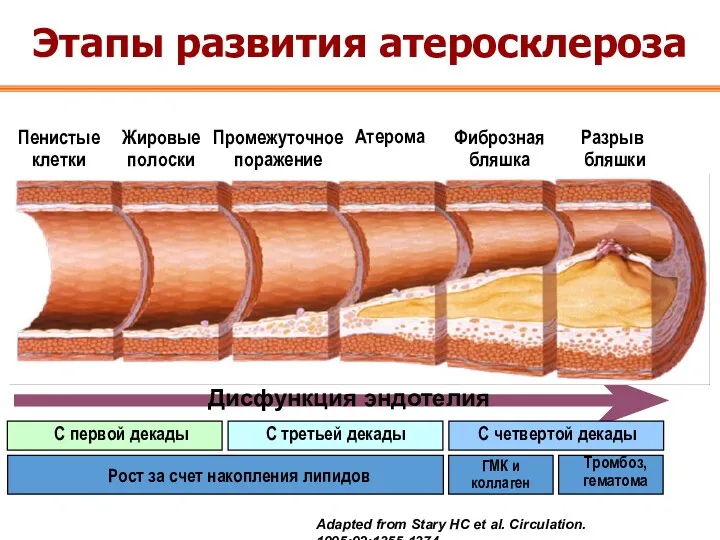 Атеросклероз Пенистые клетки Жировые полоски Промежуточное поражение Атерома Фиброзная бляшка