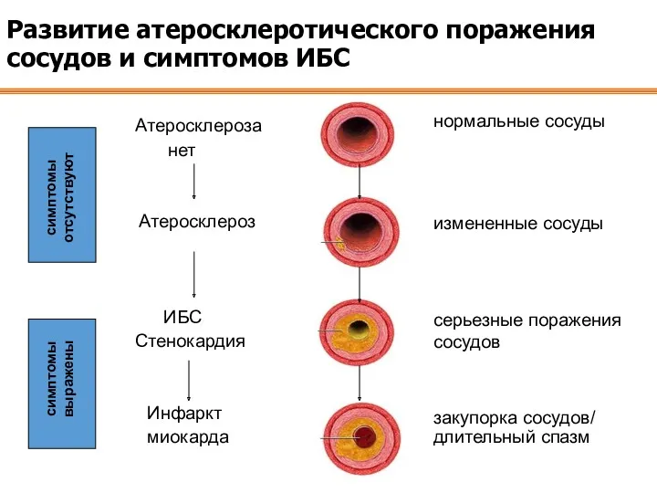 Развитие атеросклеротического поражения сосудов и симптомов ИБС Атеросклероза нет Атеросклероз