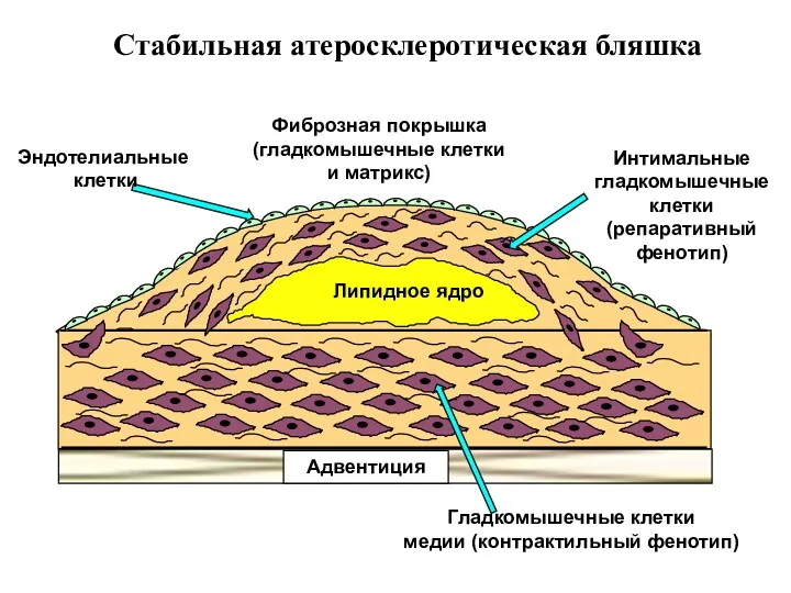 Стабильная атеросклеротическая бляшка Липидное ядро Адвентиция Фиброзная покрышка (гладкомышечные клетки