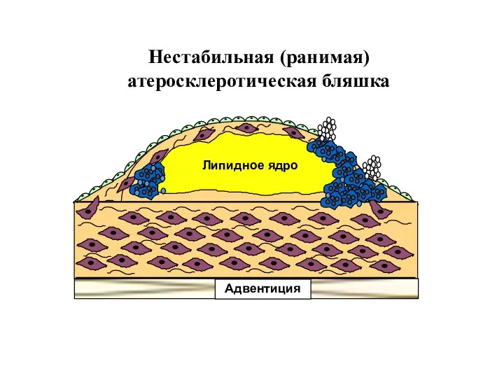 Нестабильная (ранимая) атеросклеротическая бляшка Липидное ядро Адвентиция