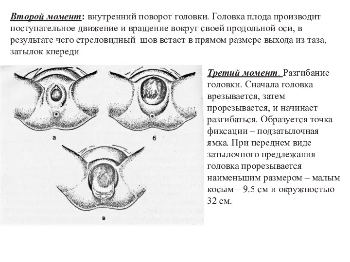 Второй момент: внутренний поворот головки. Головка плода производит поступательное движение