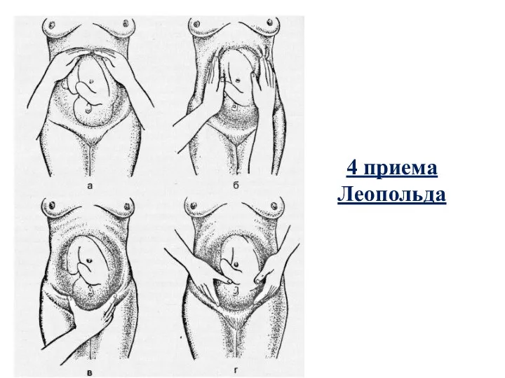 4 приема Леопольда