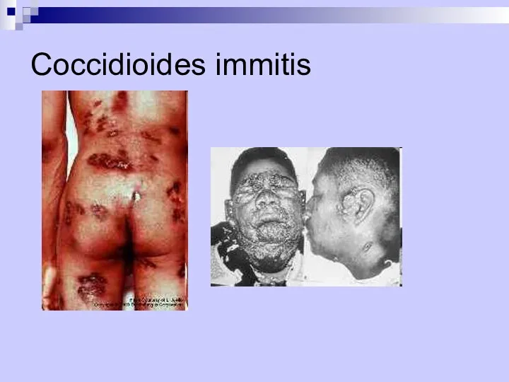 Coccidioides immitis