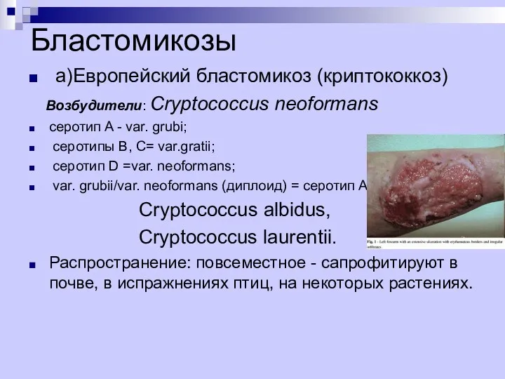 Бластомикозы а)Европейский бластомикоз (криптококкоз) Возбудители: Cryptococcus neoformans серотип A -