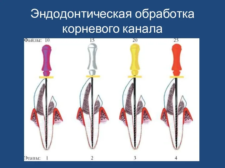 Эндодонтическая обработка корневого канала