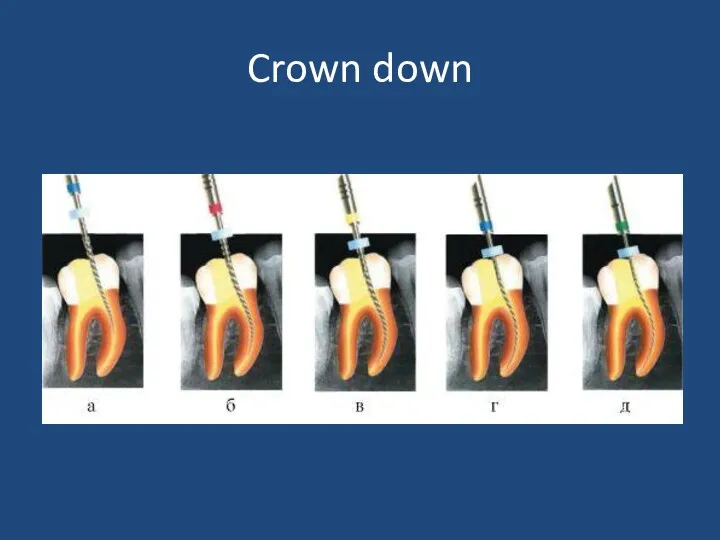 Crown down