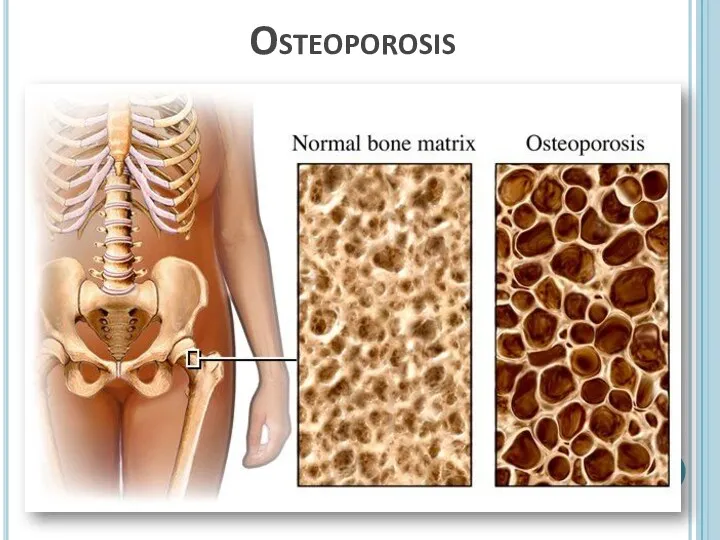 Osteoporosis