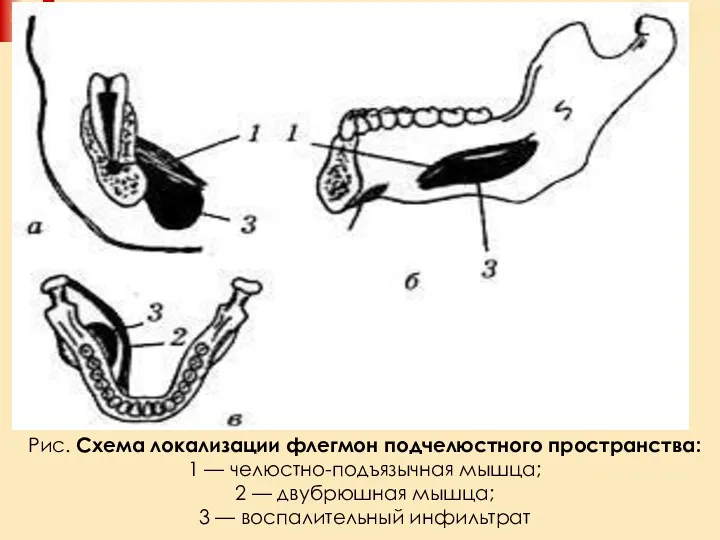 Рис. Схема локализации флегмон подчелюстного пространства: 1 — челюстно-подъязычная мышца; 2 — двубрюшная