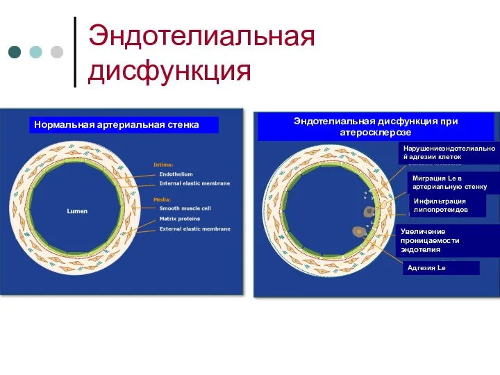 Эндотелиальная дисфункция Нормальная артериальная стенка Эндотелиальная дисфункция при атеросклерозе Нарушениеэндотелиальной