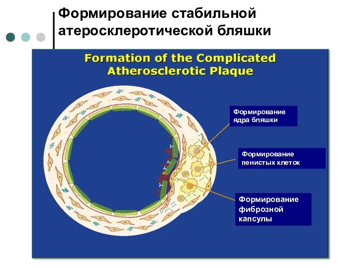 Формирование стабильной атеросклеротической бляшки Формирование ядра бляшки Формирование пенистых клеток Формирование фиброзной капсулы