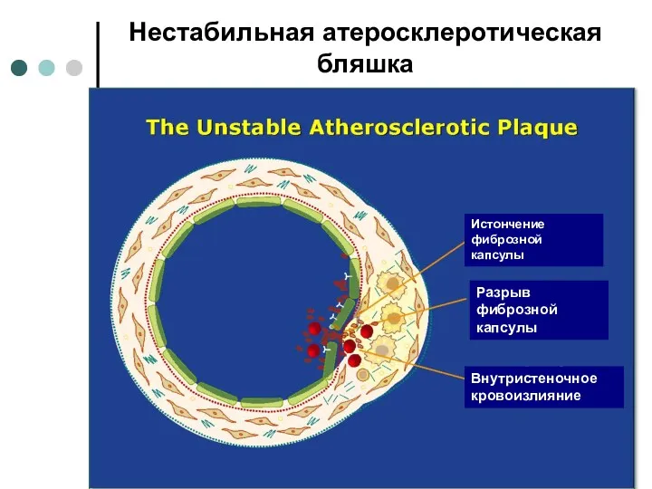 Нестабильная атеросклеротическая бляшка Истончение фиброзной капсулы Разрыв фиброзной капсулы Внутристеночное кровоизлияние