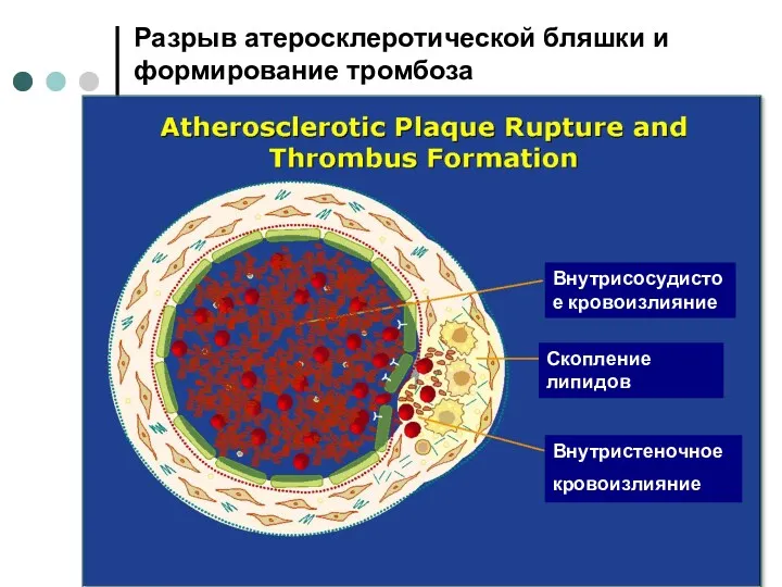 Разрыв атеросклеротической бляшки и формирование тромбоза Внутрисосудистое кровоизлияние Скопление липидов Внутристеночное кровоизлияние