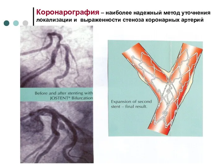 Коронарография – наиболее надежный метод уточнения локализации и выраженности стеноза коронарных артерий
