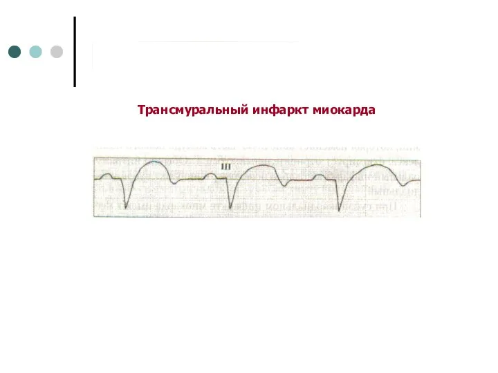 Трансмуральный инфаркт миокарда