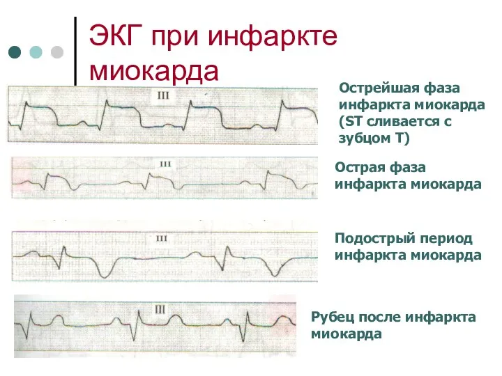 ЭКГ при инфаркте миокарда Острейшая фаза инфаркта миокарда (ST сливается