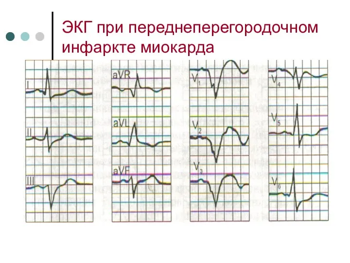 ЭКГ при переднеперегородочном инфаркте миокарда