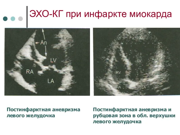 ЭХО-КГ при инфаркте миокарда Постинфарктная аневризма левого желудочка Постинфарктная аневризма