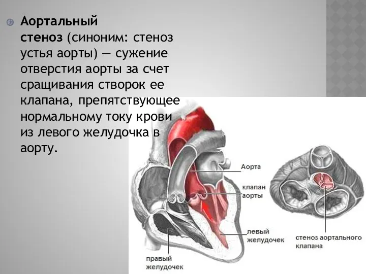 Аортальный стеноз (синоним: стеноз устья аорты) — сужение отверстия аорты за счет сращивания