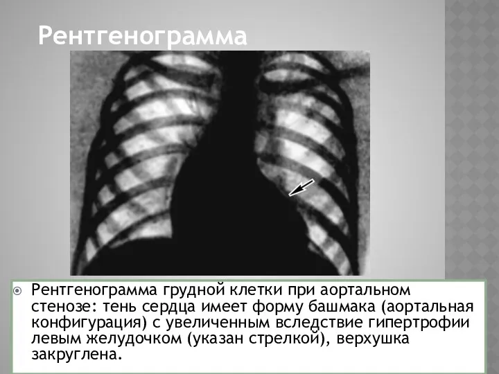 Рентгенограмма Рентгенограмма грудной клетки при аортальном стенозе: тень сердца имеет форму башмака (аортальная