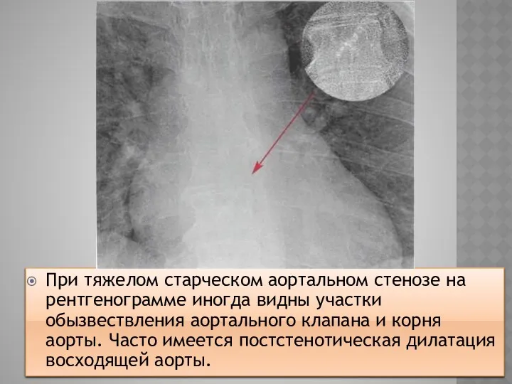 При тяжелом старческом аортальном стенозе на рентгенограмме иногда видны участки обызвествления аортального клапана