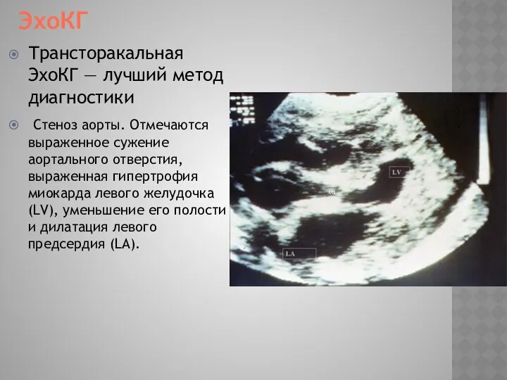 ЭхоКГ Трансторакальная ЭхоКГ — лучший метод диагностики Стеноз аорты. Отмечаются