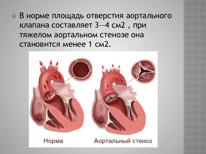 В норме площадь отверстия аортального клапана составляет 3—4 см2 , при тяжелом аортальном