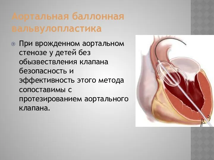 Аортальная баллонная вальвулопластика При врожденном аортальном стенозе у детей без обызвествления клапана безопасность
