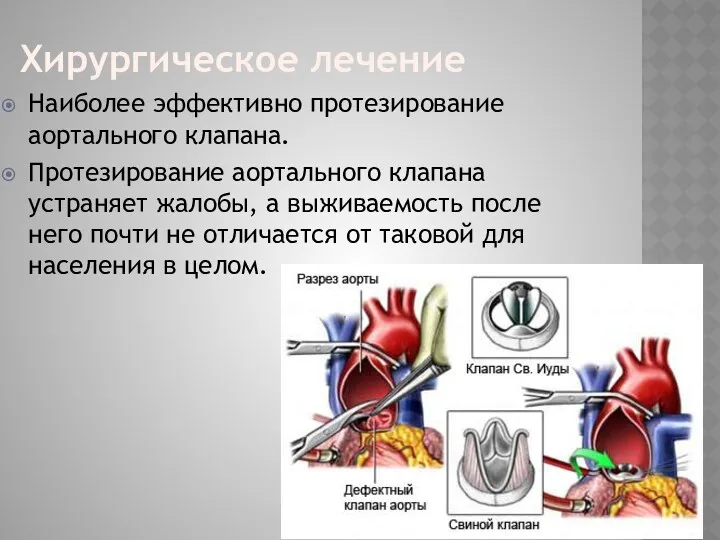 Хирургическое лечение Наиболее эффективно протезирование аортального клапана. Протезирование аортального клапана