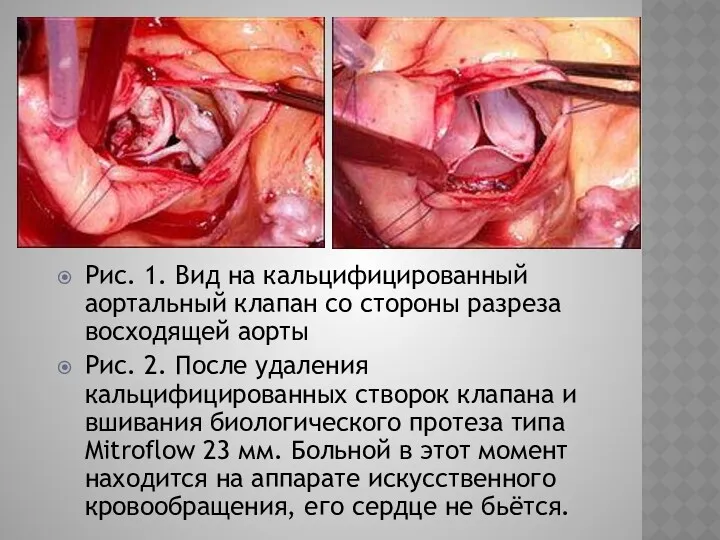 Рис. 1. Вид на кальцифицированный аортальный клапан со стороны разреза восходящей аорты Рис.