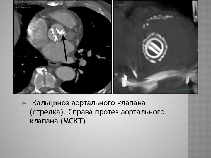 Кальциноз аортального клапана (стрелка). Справа протез аортального клапана (МСКТ)