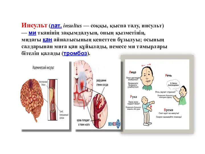 Инсульт (лат. insultus — соққы, қыспа талу, инсульт) — ми