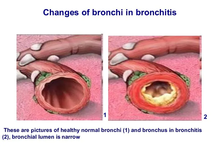 Changes of bronchi in bronchitis These are pictures of healthy