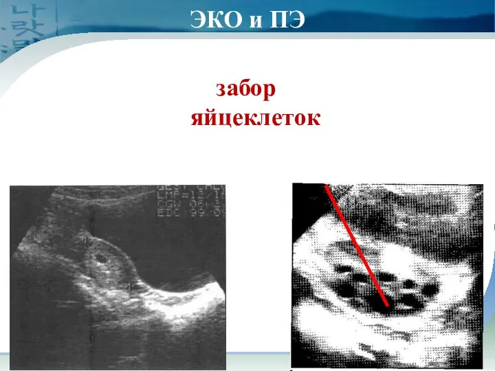 забор яйцеклеток ЭКО и ПЭ