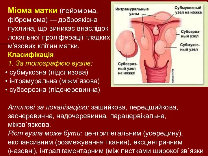 Міома матки (лейоміома, фіброміома) — доброякісна пухлина, що виникає внаслідок