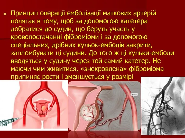 Принцип операції емболізації маткових артерій полягає в тому, щоб за