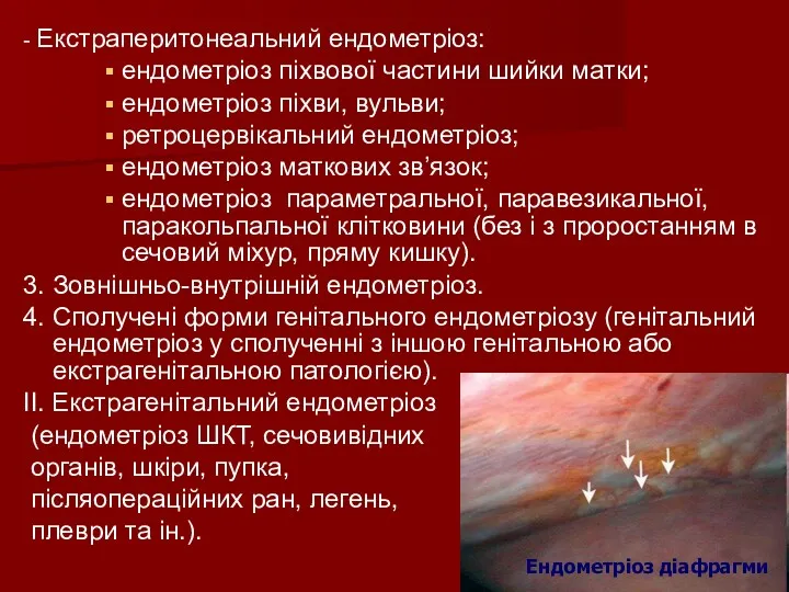 - Екстраперитонеальний ендометріоз: ендометріоз піхвової частини шийки матки; ендометріоз піхви,